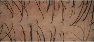 Hair Thickness, close-up scalp, even lighting
