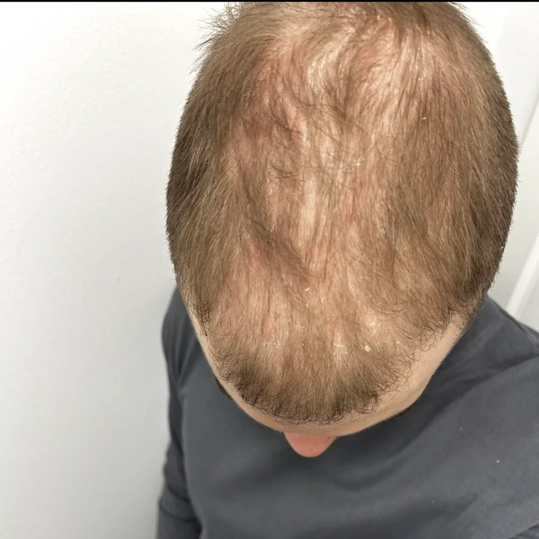 Spot Analysis, scalp with visible flakes